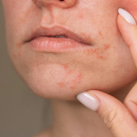 Perioral Dermatitis: how chemical-laden products trigger this stubborn rash